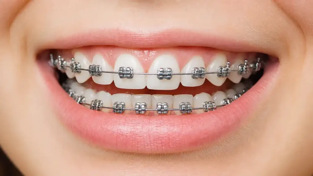 brackets ortodoncia invisible
