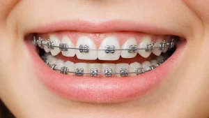 ortodoncia braquets